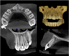 CBCT